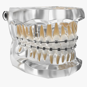transparent dental typodont bracket 3D model