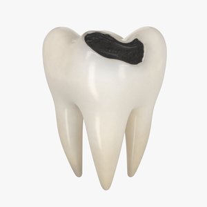 teeth decay 3D model
