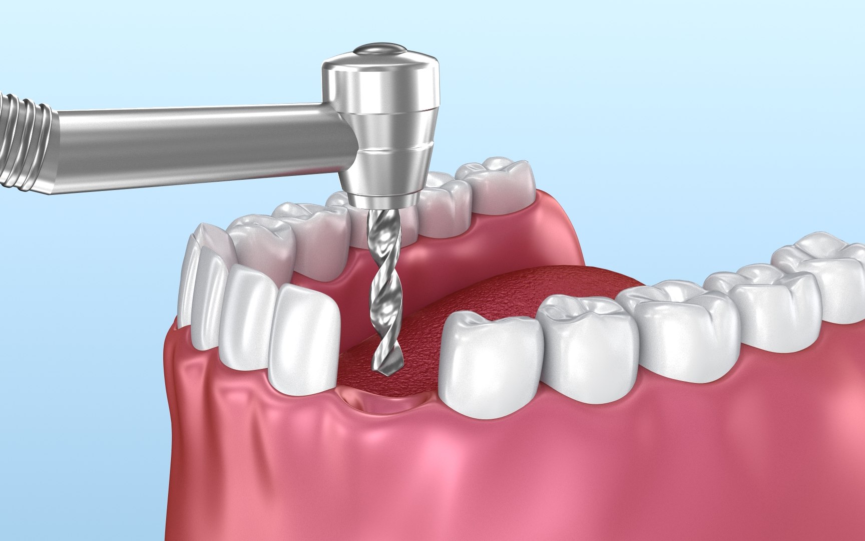 dental-implant-instalation-animation-3d-model-turbosquid-1463471