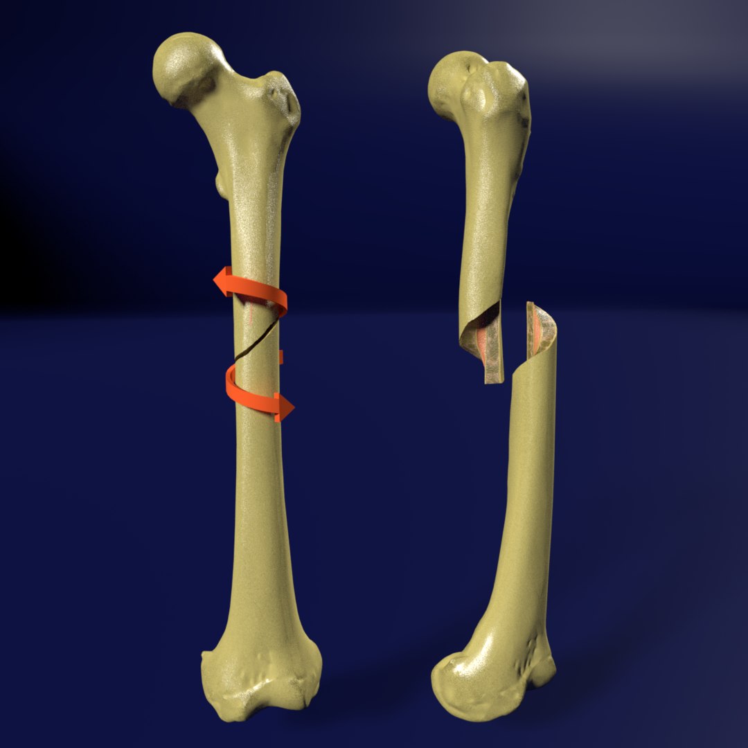 types-of-tibia-fracture-welcome-to-sys-medtech-international-pvt-ltd