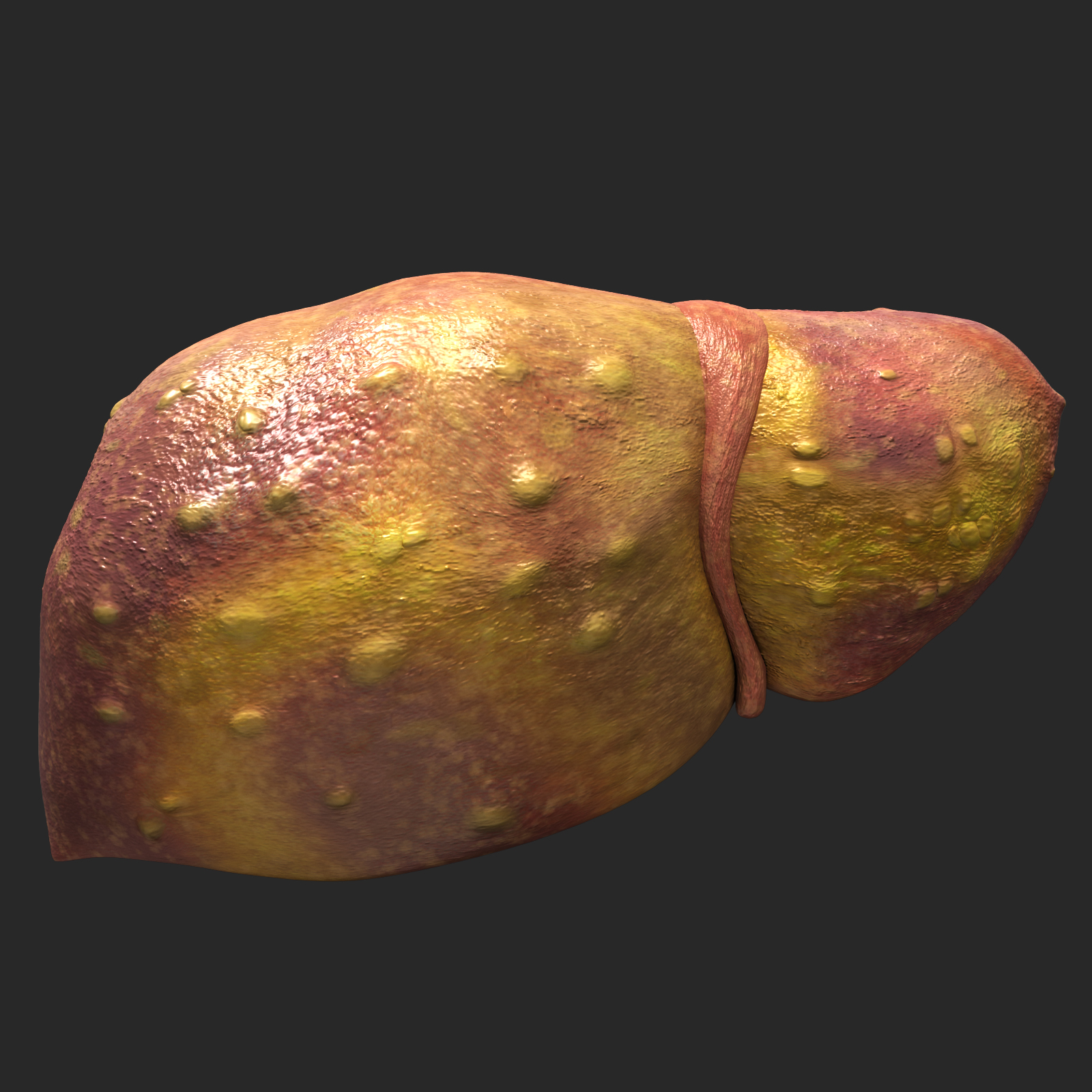 3d liver cirrhosis