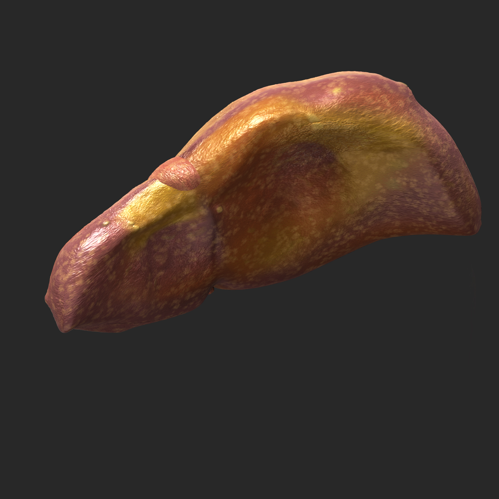 3d liver cirrhosis