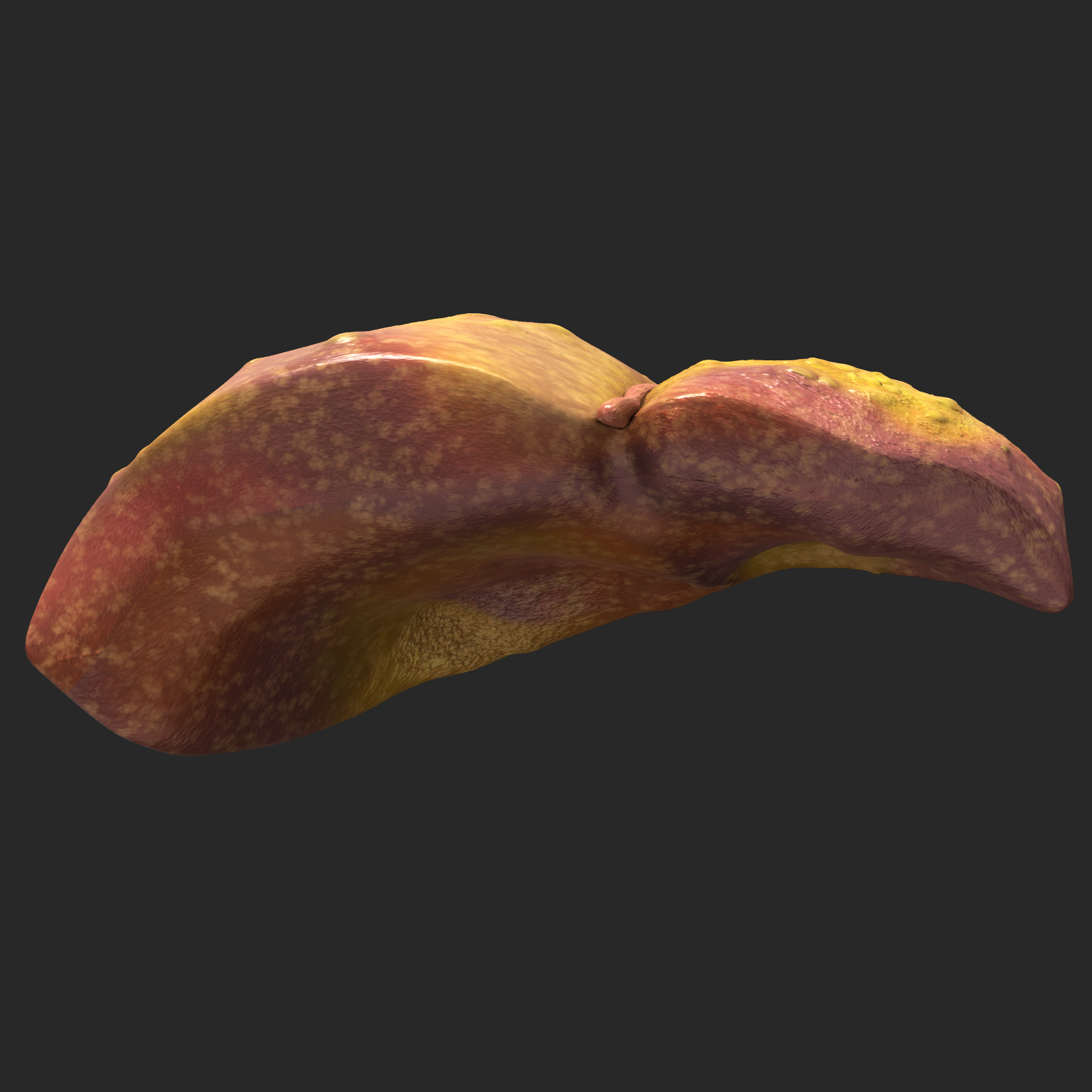 3d liver cirrhosis