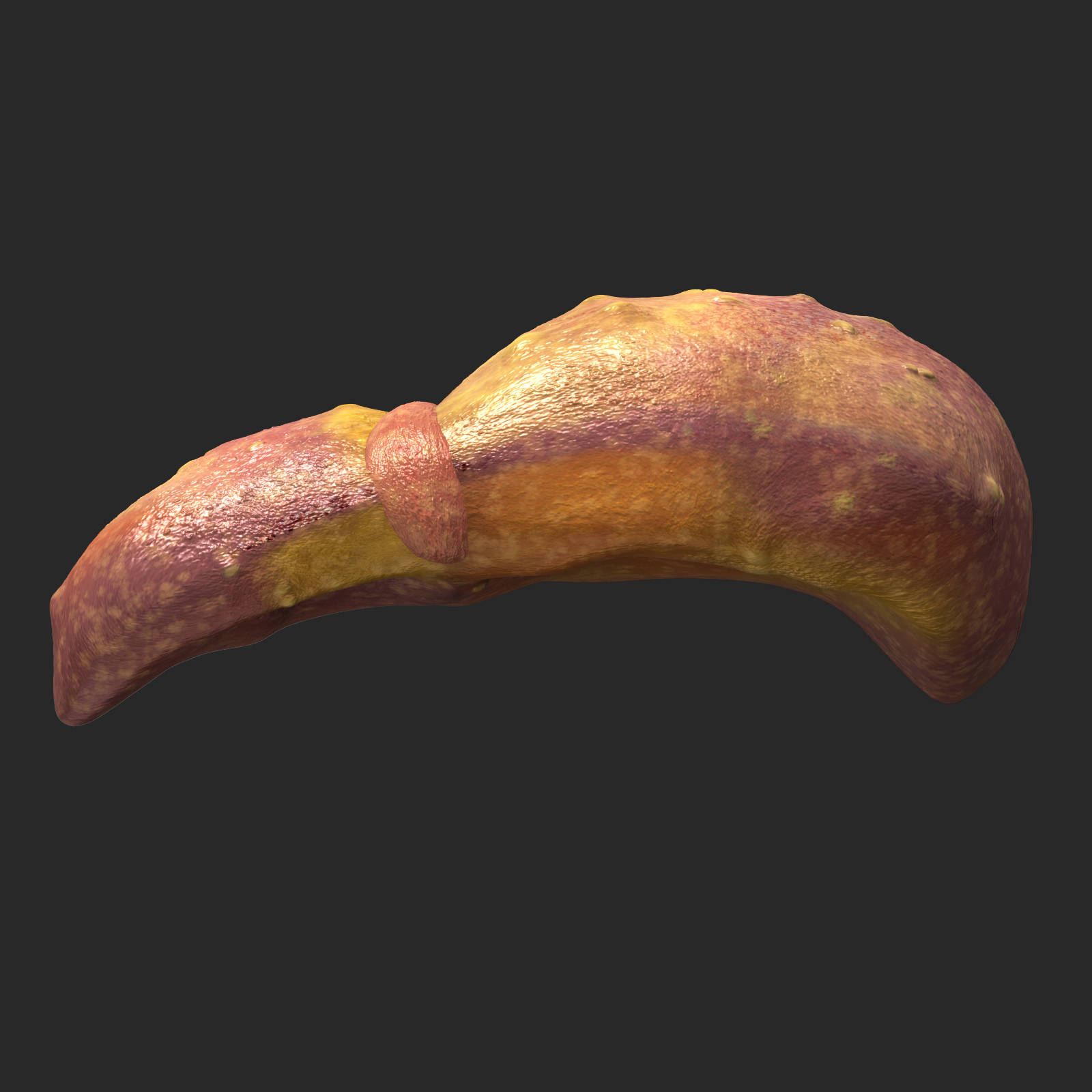 3d liver cirrhosis