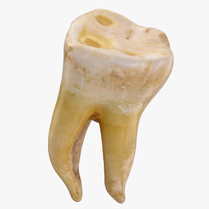 3D molar upper jaw right