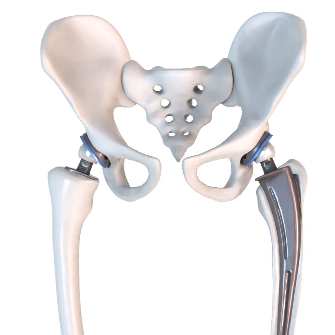 Hip Replacement Implant Installed Model - Turbosquid 1507568