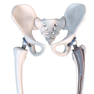 hip replacement implant installed model