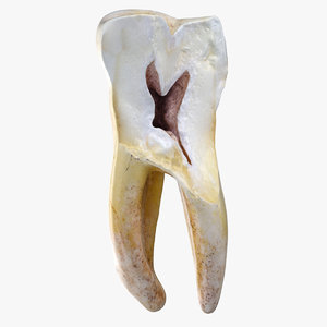 3D model molar lower left jaw