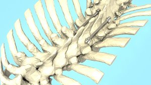 3D spine implant