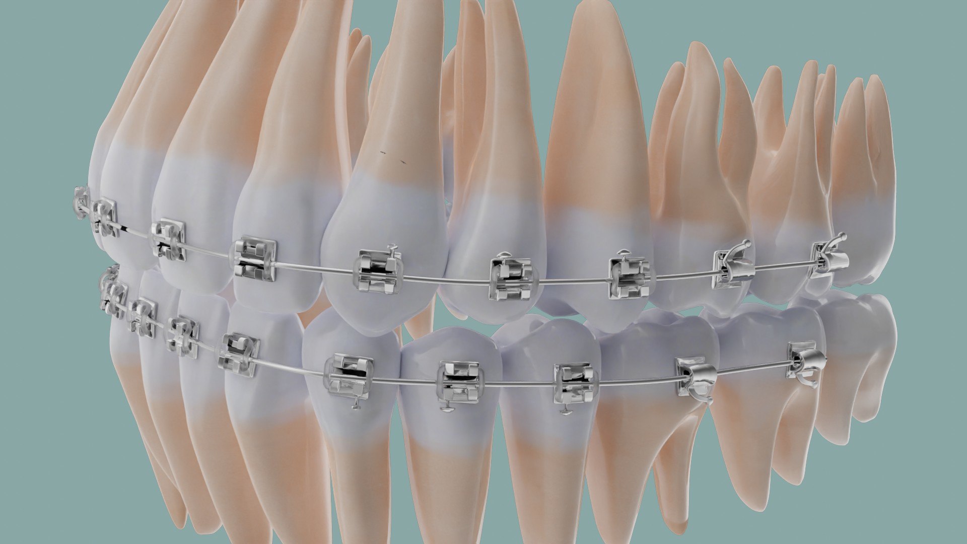 Braces orthodontics 3D model - TurboSquid 1567260