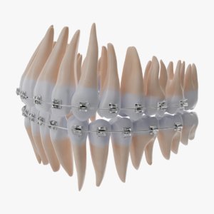 Free 3D Braces Models | TurboSquid